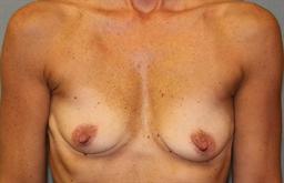 Front of breasts before surgery