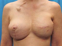 Front of breasts after surgery