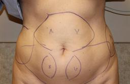 Front of abdomen before surgery