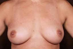 Front of breasts before surgery