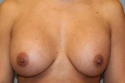 Front of breasts after surgery