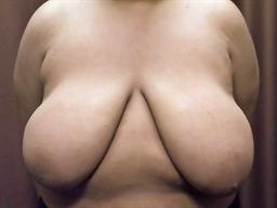 Front of breasts before surgery