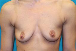 Front of breasts before surgery