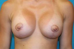 Front of breasts after surgery