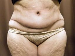 Front of abdomen after surgery