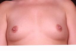 Front of breasts before surgery