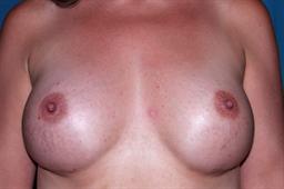 Front of breasts after surgery