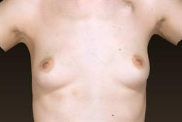 Front of breasts before surgery