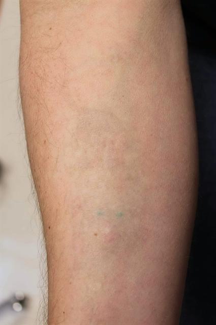 After 23 treatments