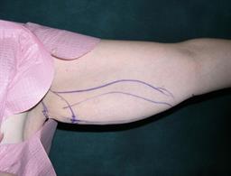 Front of left arm before arm lift