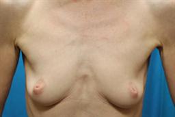 Front of breasts before surgery