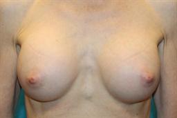 Front of breasts after surgery