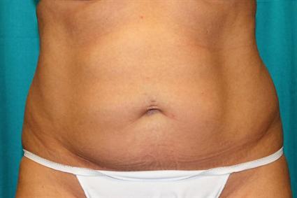 After 4 mos.