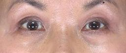 After 6 wks.