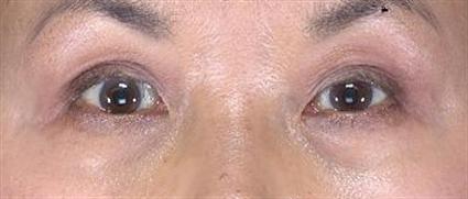 After 6 wks.