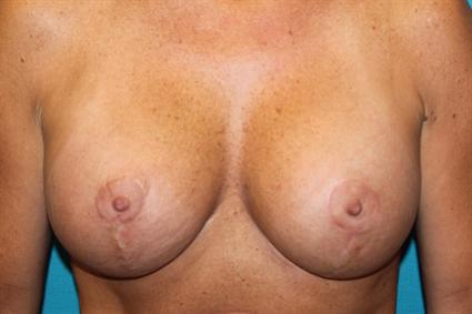 After 7 wks.