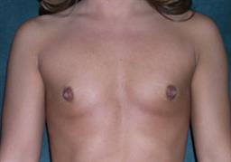 Front of breasts before surgery