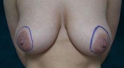 Front of breasts before surgery