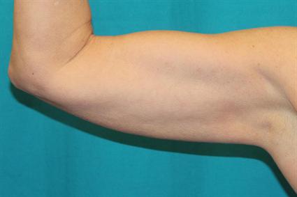 After 5 mos.