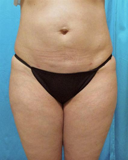 After 5 wks.