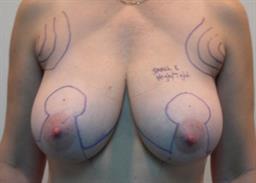 Front of breasts before surgery