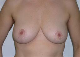 Front of breasts after surgery