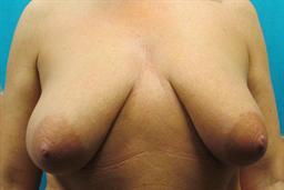 Front of breasts before surgery