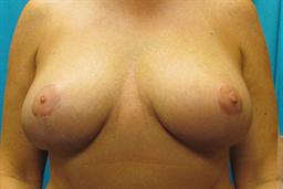 Front of breasts 3 months after surgery