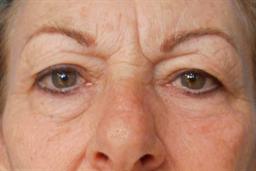 front of face before upper blepharoplasty