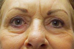 front of face 6 wks. after upper blepharoplasty