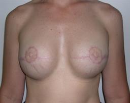Front of breasts after reconstruction surgery