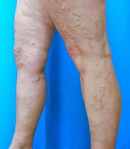 Left view of leg before vein treatments