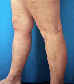 Left view of leg 12 mos. after vein treatments