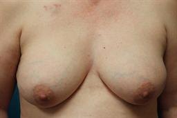 Front of breasts before surgery