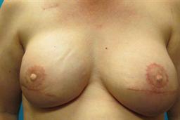 Front of breasts after surgery