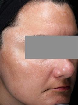 Right view of face before skin care program