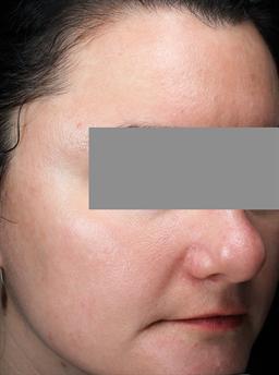Right view of face after skin care program