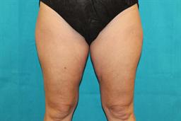 Front view of thighs before CoolSculpting