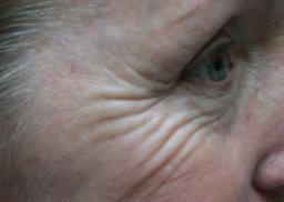 Right view of crows feet before Botox