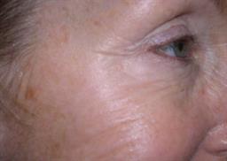 Right view of crows feet 2 weeks after Botox