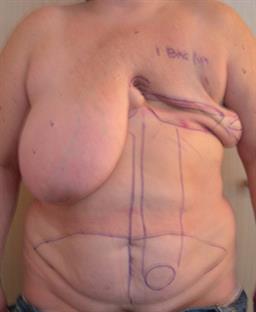 Front of breasts before surgery