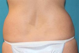 Back flanks 7 months after liposuction