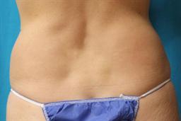 Back flanks 2 mos after Coolsculpting