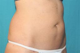 After liposuction but before Coolsculpting
