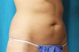 2 mos after Coolsculpting