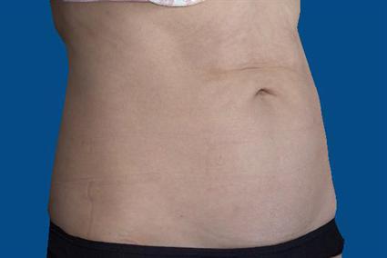 After 4 weeks Photo