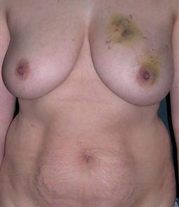 Front of breasts before surgery