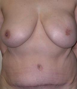 Front of breasts after surgery