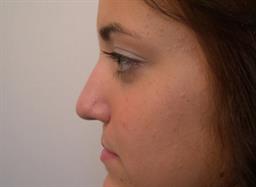 Left side of face before rhinoplasty