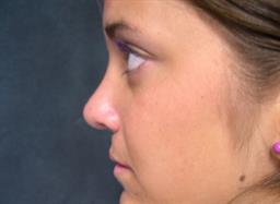 Left side of face after rhinoplasty